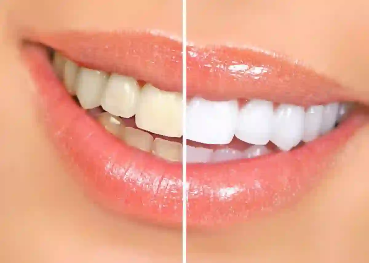 Teeth before and after professional whitening