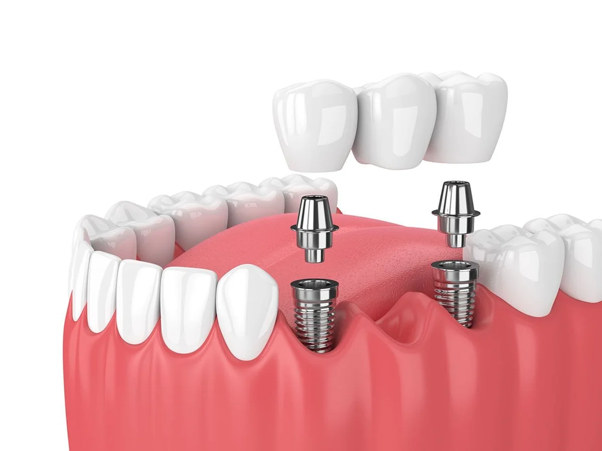 Dental implants supporting a bridge