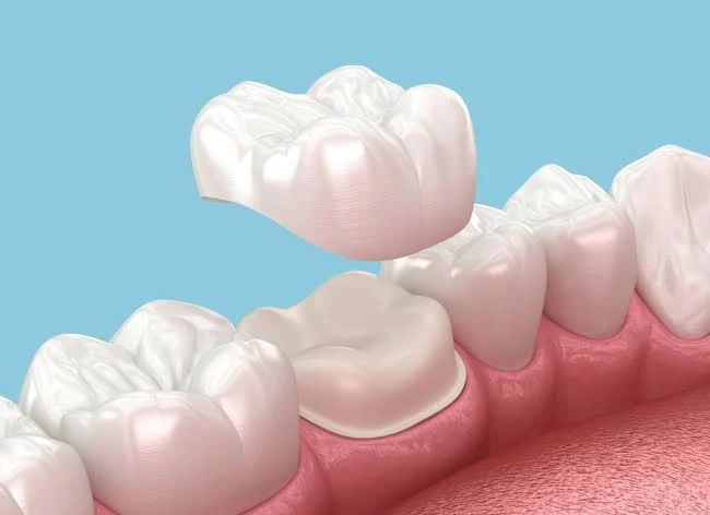 Porcelain dental crowns